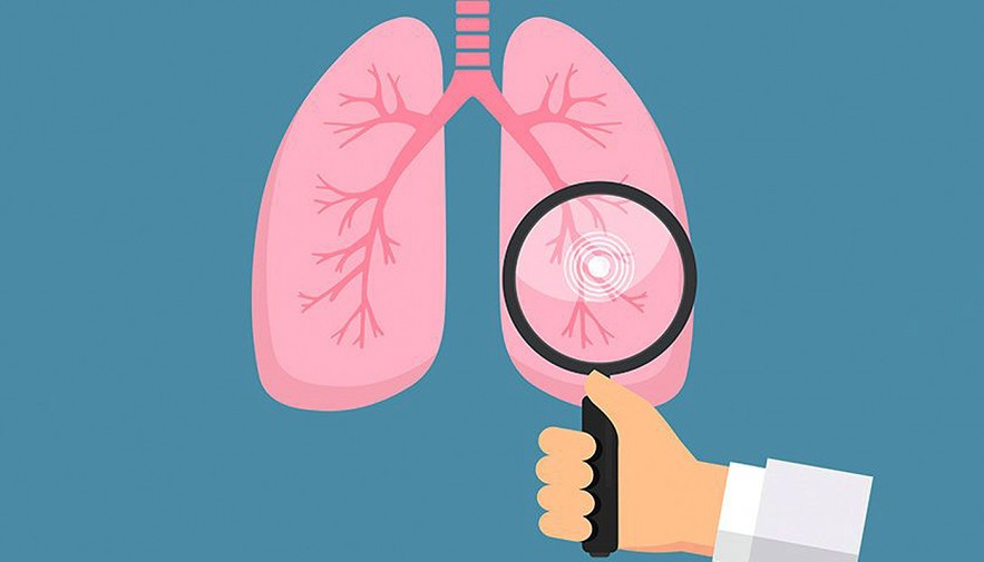 Secretaria da Saúde do Tocantins alerta para a prevenção da tuberculose durante o mês de março