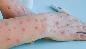 Dois casos suspeitos de varíola dos macacos são acompanhados em Palmas